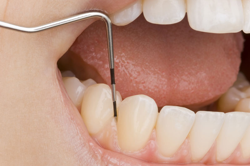 Scaling & Deep Cleaning - Periodontal Therapy - The Brooklyn Dentist
